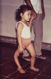 A child displaying a deformity of her right leg due to polio