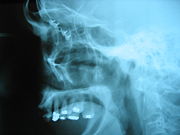 This left lateral cephalametric radiograph shows a profile of the human skull.  A fracture of the eye socket was repaired by stabilizing the fractured bones with small titanium plates and screws.
