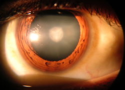 Cataract in Human Eye- Magnified view seen on examination with a slit lamp