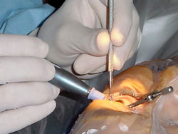 Cataract surgery, using a temporal approach phacoemulsification probe (in right hand) and "chopper"(in left hand) being done under operating microscope at a Navy medical center