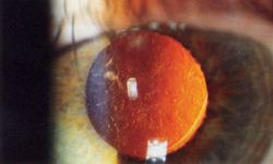 Slit lamp photo of IOL showing Posterior capsular opacification visible few months after implantation of Intraocular lens in eye, seen on retroillumination