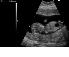 Ultrasound of fetus with Down syndrome and megacystis