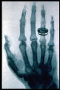 Roentgen X-ray (23 Jan. 1896).