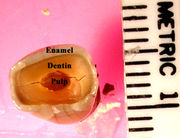 The effects of bruxism on an anterior tooth, revealing the dentin and pulp which are normally hidden by enamel.