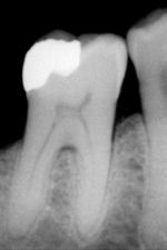 An X-ray showing enamel and dentin replaced by an amalgam restoration.