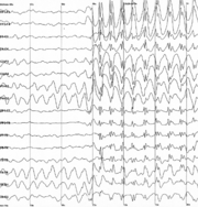 Generalized 3 Hz spike and wave discharges in EEG