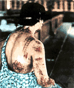 Burns visible on a woman in Hiroshima during the blast, darker colors of her kimono at the time of detonation correspond to clearly visible burns on skin touching parts of the garment exposed to thermal radiation. Since kimonos are not form fitting attire, some parts were not directly touching her skin are visible as breaks in the pattern. As well as tighter fitting areas approaching the waistline where the pattern is much more defined.