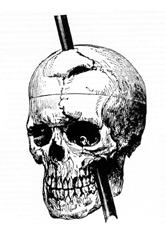 Illustration from Harlow's 1868 paper: "Front and lateral view of the cranium, representing the direction in which the iron traversed its cavity; the present appearance of the line of fracture, and also the large anterior fragment of the frontal bone, which was entirely detached, replaced and partially re-united."