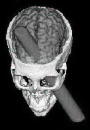 This computer generated graphic, based on data from a "standard human skull", shows how the tamping rod may have penetrated Phineas Gage's skull, crossing the midline and damaging both frontal lobes, according to Damasio et al.
