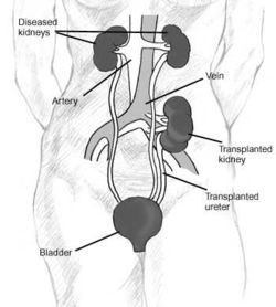 Diagram illustrating a typical kidney transplant such as those Woodruff performed in Edinburgh.