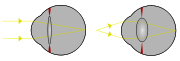 Light from a single point of a distant object and light from a single point of a near object being brought to a focus on the retina