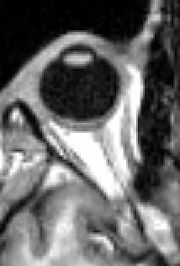 MRI scan of human eye