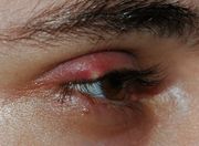The stye is a common irritating inflammation of the eyelid.
