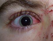 An example of eye trauma.