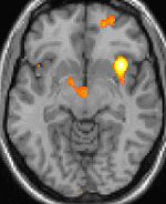 Positron emission tomography functional imaging shows activation of specific brain areas during a cluster headache.