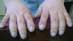 Clubbing of fingers secondary to pulmonary hypertension in a patient with Eisenmenger's syndrome. First described by Hippocrates, clubbing is also known as "Hippocratic fingers"