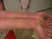 More severe eczema