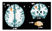 Results from an fMRI experiment in which people made a conscious decision about a visual stimulus. The small region of the brain coloured orange shows patterns of activity that correlate with the decision making process. Crick stressed the importance of finding new methods to probe human brain function.