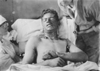 A soldier with mustard gas burns, 1917/1918.