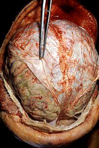 An autopsy demonstrating signs of pneumococcal meningitis. The forceps (center) are retracting the dura mater (white).  Underneath the dura mater are the leptomeninges, which are edematous and have multiple small hemorrhagic foci (red).