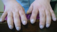 Clubbing Patients with CF can often have enlargement of their fingers, Extreme case shown here.