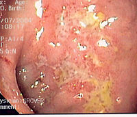 Endoscopy image of colon showing serpiginous ulcer, a classic finding in Crohn's disease