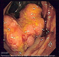 Endoscopic image of colon cancer identified in the sigmoid colon (anatomy) on screening colonoscopy for Crohn's disease.