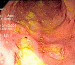 Endoscopic image of Crohn's colitis showing deep ulceration