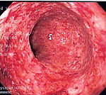 Crohn's disease can mimic ulcerative colitis on endoscopy. This endoscopic image is of Crohn's colitis showing diffuse loss of mucosal architecture, friability of mucosa in sigmoid colon and exudate on wall, all of which can be found with ulcerative colitis.
