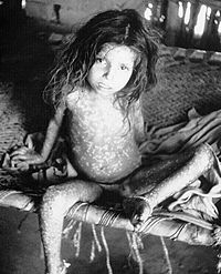 Child showing rash due to ordinary-type smallpox (variola major)