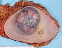 Mastectomy specimen containing a large cancer of the breast (in this case, an invasive ductal carcinoma).