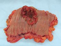 Colectomy specimen containing an invasive colorectal carcinoma (the crater-like, reddish, irregularly-shaped tumor).