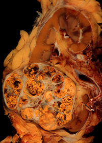 Nephrectomy specimen containing a renal cell carcinoma (the yellowish, spongy-looking tumor in the lower left).