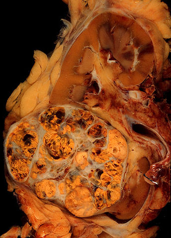 Image:Renal cell carcinoma.jpg