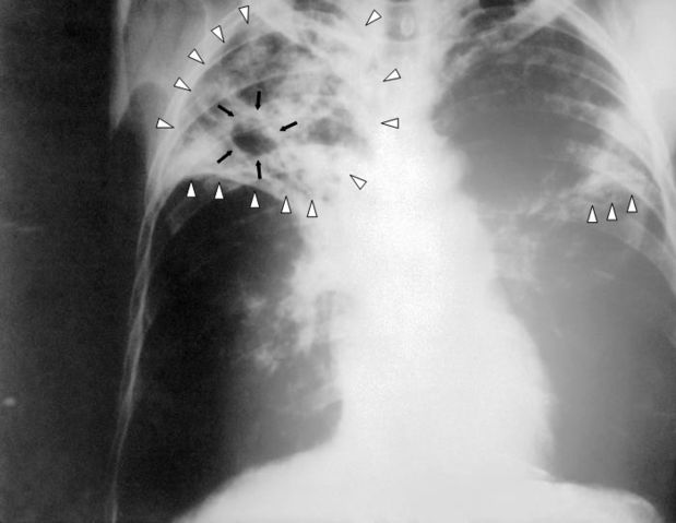 Image:Tuberculosis-x-ray-1.jpg
