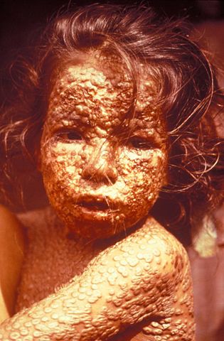 Image:Child with Smallpox Bangladesh.jpg