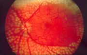 Image of fundus showing scatter laser surgery for diabetic retinopathy