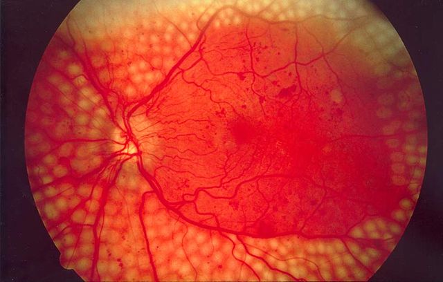 Image:Fundus photo showing scatter laser surgery for diabetic retinopathy EDA09.JPG