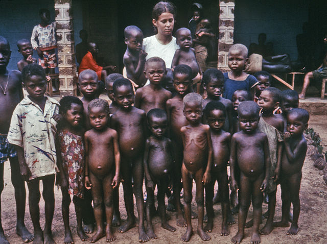 Image:Kwashiorkor 6903.jpg