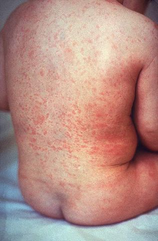 Image:Rash of rubella on skin of child's back.JPG