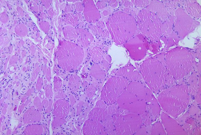 Image:PHIL 2767 Poliovirus Myotonic dystrophic changes.jpg