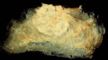 This mastectomy specimen contains an infiltrating ductal carcinoma of the breast. A pathologist will use immunohistochemistry and fluorescent in-situ hybridization to detect markers which determine the optimal chemotherapy regimen for this patient.