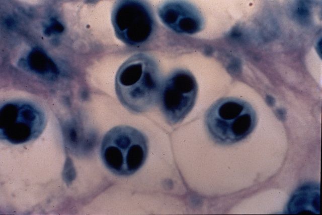 Image:Whirling disease pathology.jpg