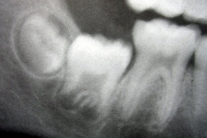 Radiograph of lower right (from left to right) third, second, and first molars in different stages of development.