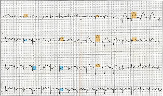 Image:12 Lead EKG ST Elevation tracing color coded.jpg