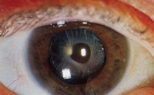 Image:Anterior capsular opacification.jpg