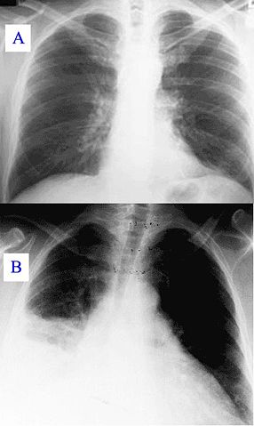 Image:Pneumonia x-ray.jpg
