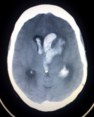 Image:Intracerebral heamorrage 2.jpg